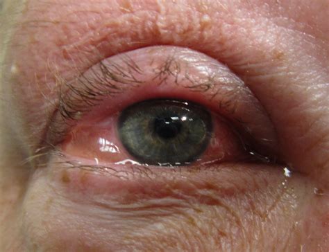 Pink Eye Home Remedy - FastMed