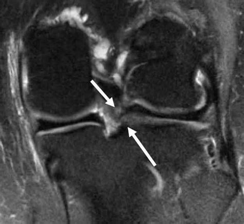 Medial Meniscus Tear