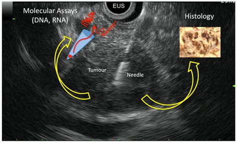 Cancers | Free Full-Text | Molecular Endoscopic Ultrasound for ...