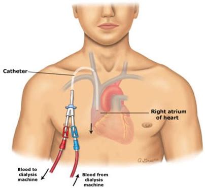 Permcath Insertion | Varicose veins | Vascular surgeon | Stroke | DVT ...