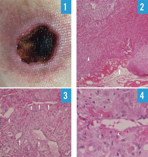 Ecthyma Gangrenosum Histology