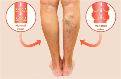 Varicose Veins Treatment and Surgical Procedure Options