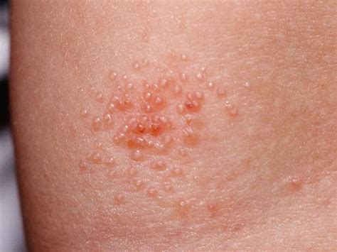 Molluscum Contagiosum - Dermatology Surgery Center - Niceville, FL ...