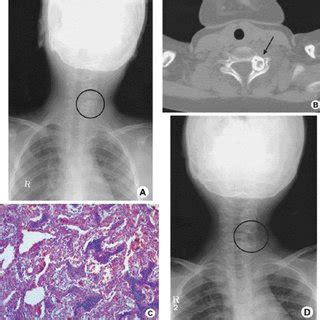 (PDF) Osteoid Osteoma and Osteoblastoma of the Spine