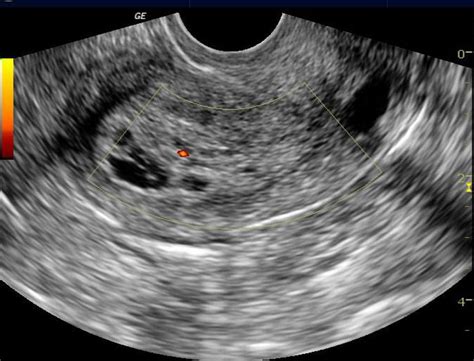 Endometrial hyperplasia ultrasound - wikidoc