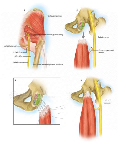 Proximal Hamstring Tendon Repair - Adam Watson Orthopaedic Surgeon