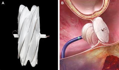 State-of-the-Art Atrial Septal Defect Closure Devices for Congenital ...