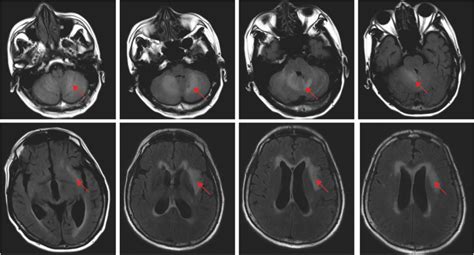 Plain head MRI: Abnormal signals in the left lateral capsule, insular ...