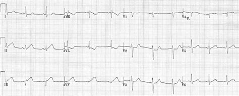 Inferior STEMI • LITFL • ECG Library Diagnosis