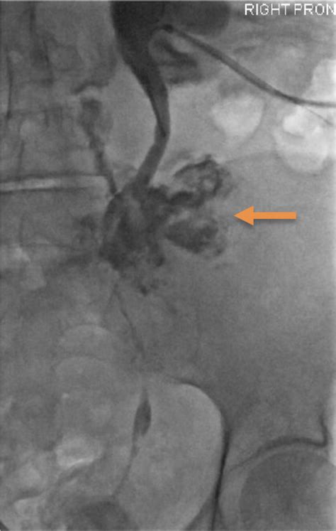 Figure 2 from A rare complication of urinary catheter insertion ...