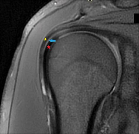 A plane-based approach for the characterization of supraspinatus tendon ...