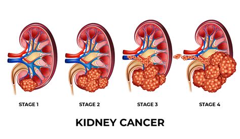 Kidney Cancer - Feifer Urology