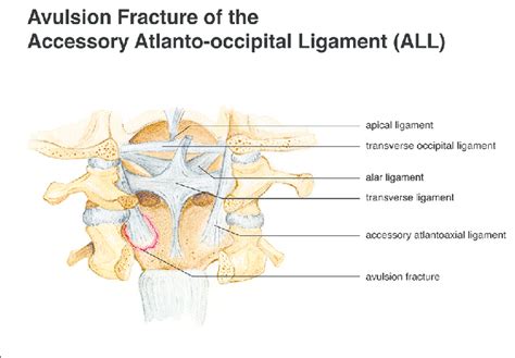 Artist's representation of an avulsion fracture of the atlantoaxial ...