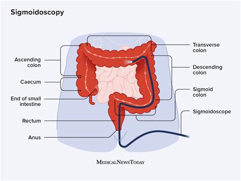 Sigmoidoscopy: What is it, uses, and what to expect