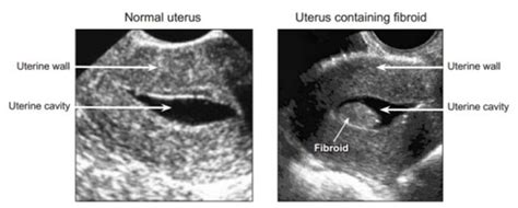 Sonohysterogram | Repromed Fertility Center, Dallas TX