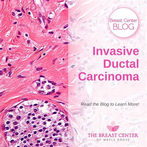 Invasive Ductal Carcinoma | IDC Breast Cancer | BCMG