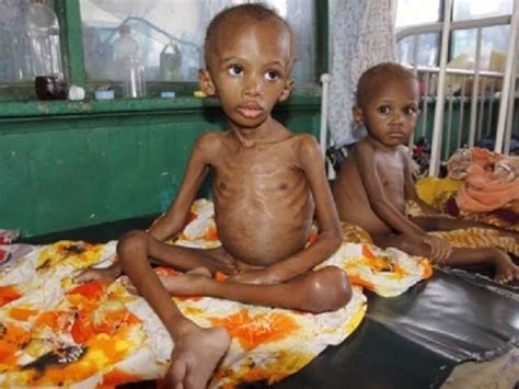 MALNUTRITION: What Nigeria should do to attain SDGs