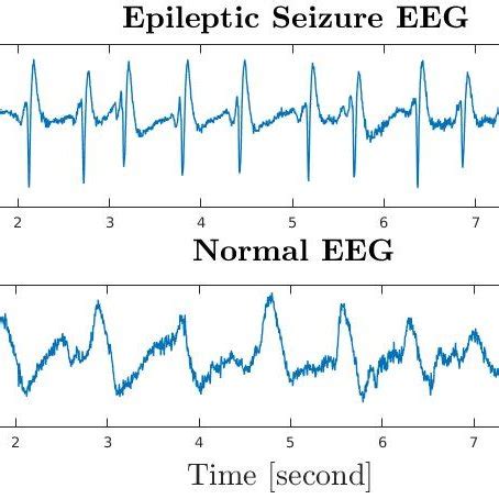 Epileptic Seizure EEG vs Normal EEG. | Download Scientific Diagram