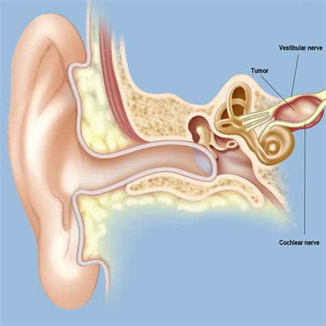 Acoustic Neuromas / Vestibular Schwannomas | Brain & Spine Center