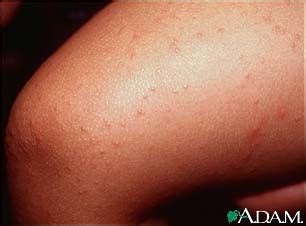 Got HBV? What is Your Skin Trying to Tell You? - Hepatitis B Foundation