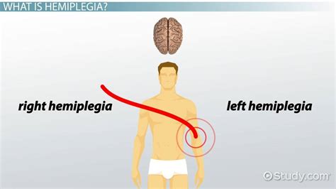 What Is Hemiplegia? - Definition, Symptoms & Treatment - Lesson | Study.com