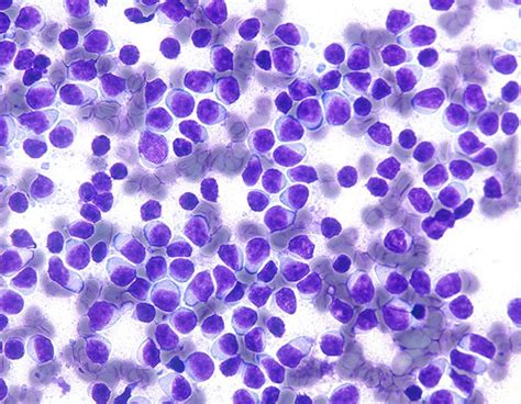 17 Best images about Chronic Lymphocytic Leukemia on Pinterest | Red ...