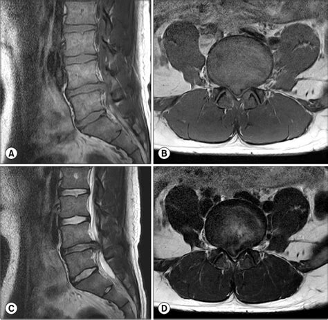 Lumbar Spine Mri Labeled