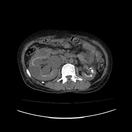 Medullary nephrocalcinosis | Radiology Reference Article | Radiopaedia.org