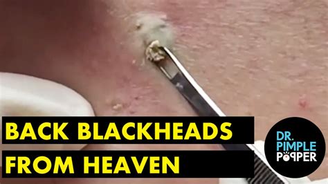 Back Blackheads from Heaven - Dr. Pimple Popper