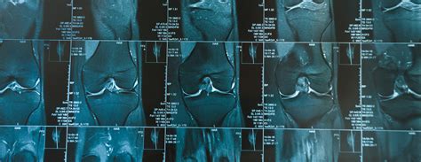 Knee MRI scan