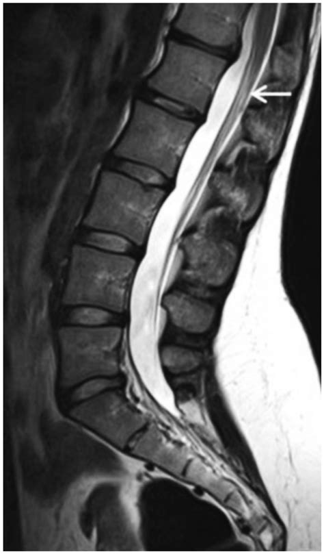 Lumbar Spine Sagittal