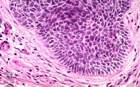 Skin Under the Microscope: Basal Cell Carcinoma of skin (Image ...