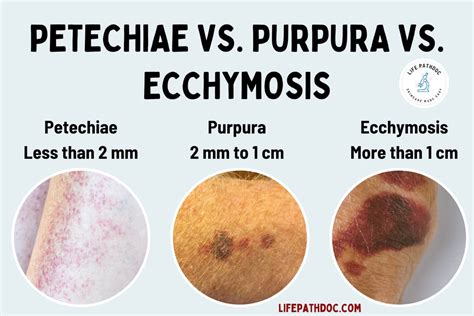 Petechiae Purpura Ecchymosis Size