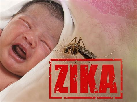 Scans, Ultrasound Spot Zika Brain Defects