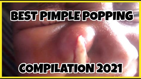 BEST PIMPLE POPPER COMPILATION 2021 - YouTube