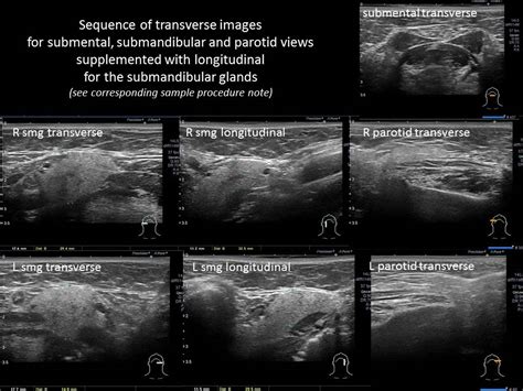 Submandibular Gland Ultrasound