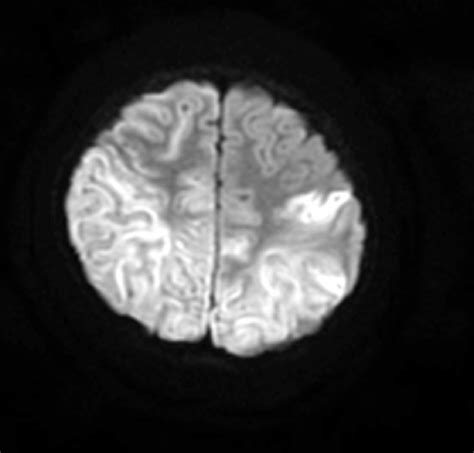 Showing MRI image of encephalopathy with restricted diffusion ...