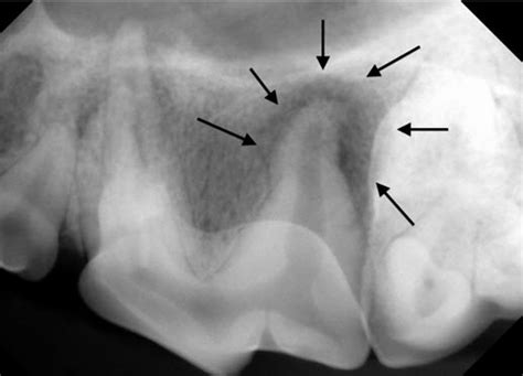 Periapical Abscess Radiograph