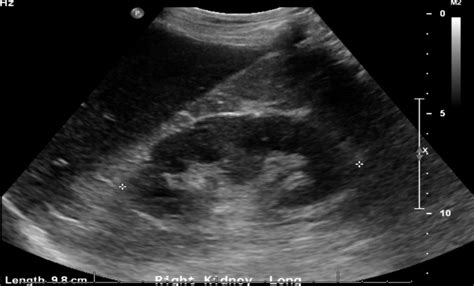 Hiding in Plain Sight: A Case of Perinephric Abscess Diagnosed by POCUS ...