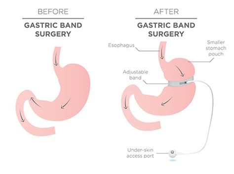 Laparoscopic Adjustable Gastric Band & Banded Sleeve at COMS Clinic