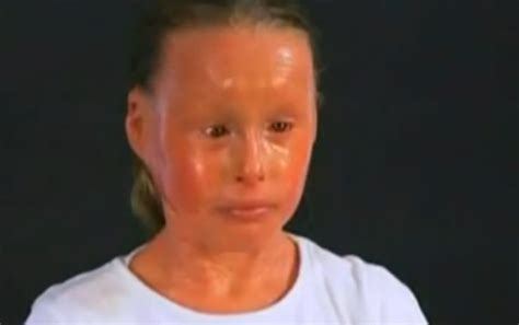 Harlequin Ichthyosis – Pictures, Survivors, Causes, Treatment