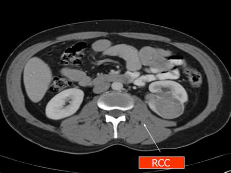 Oncology: RENAL TUMORS