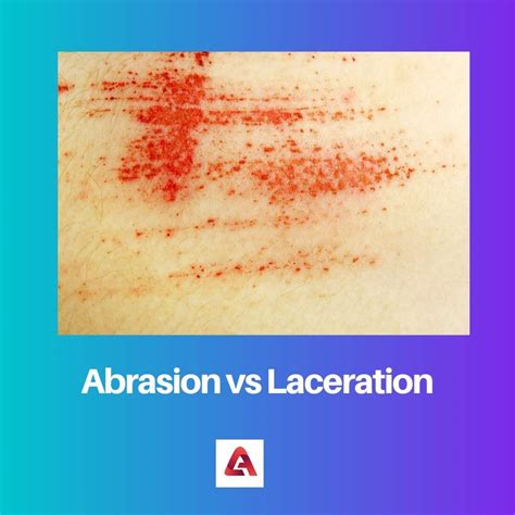 Abrasion vs Laceration: Difference and Comparison