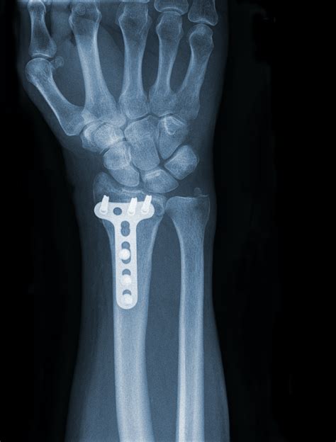 Orthopedic implant applications | Ionbond IHI Group