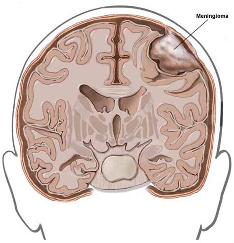 Meningioma