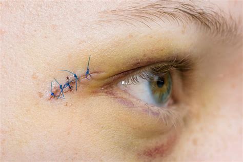 Human Face Stitches Scar Human Eye Stock Photos, Pictures & Royalty ...