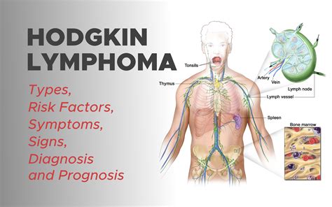 Hodgkin Lymphoma: Types, Risk Factors, Symptoms, Signs, Diagnosis and ...