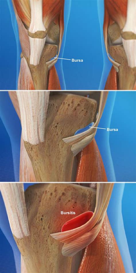 Goosefoot (Pes Anserine) Bursitis of the Knee - Orthoriverside.com