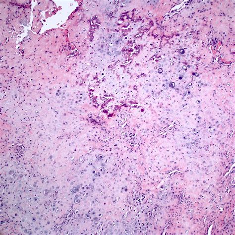 Histology Of Osteosarcoma