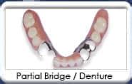 Dental Bridge - Removable | Delta Dentist Chandler AZ 85226